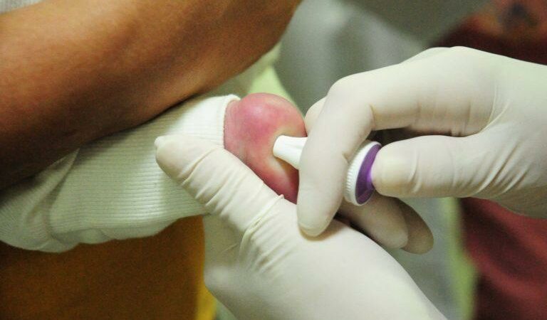 MT Hemocentro atende 599 pacientes com a doença falciforme